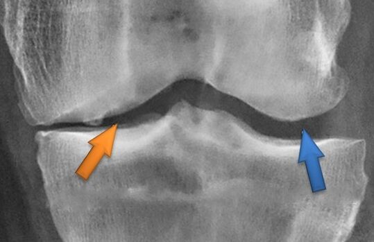 Kinesitherapy για αρθρίωση